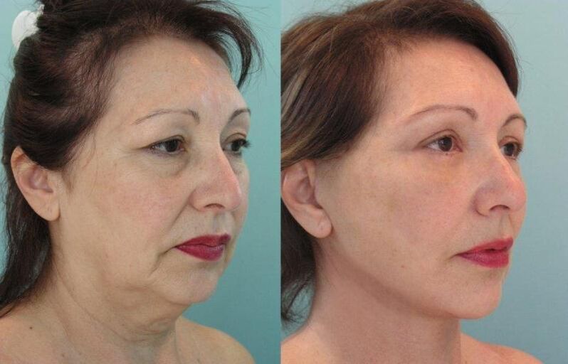 通过用线收紧面部皮肤使面部皮肤恢复活力的结果。